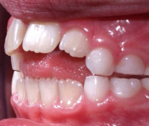 Pacifier teeth image