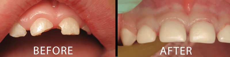 Before and After teeth images