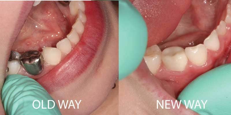 Types of Treatment - Children's Dentistry