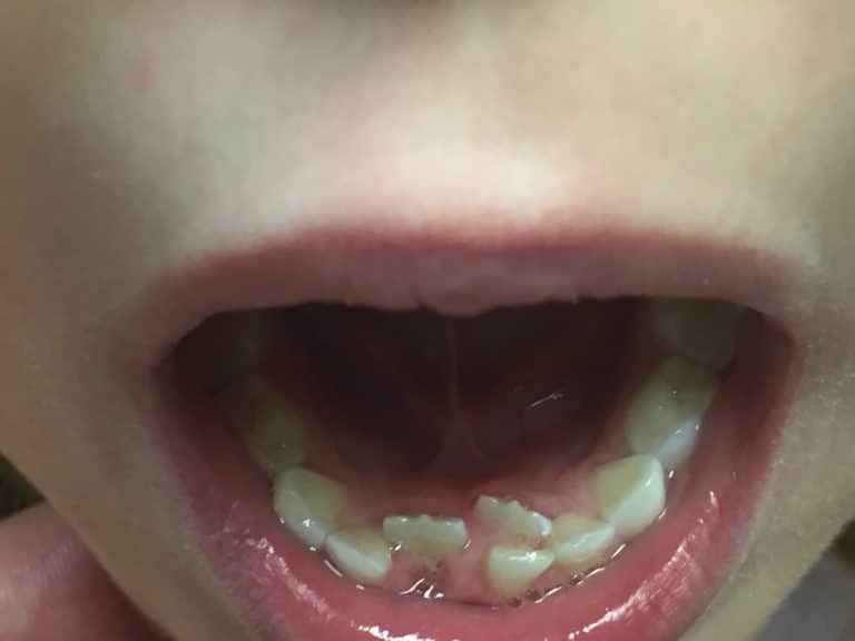 Do Your Kids Have Shark Teeth?