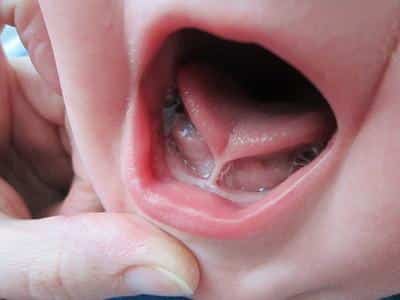 Tongue-tied baby image